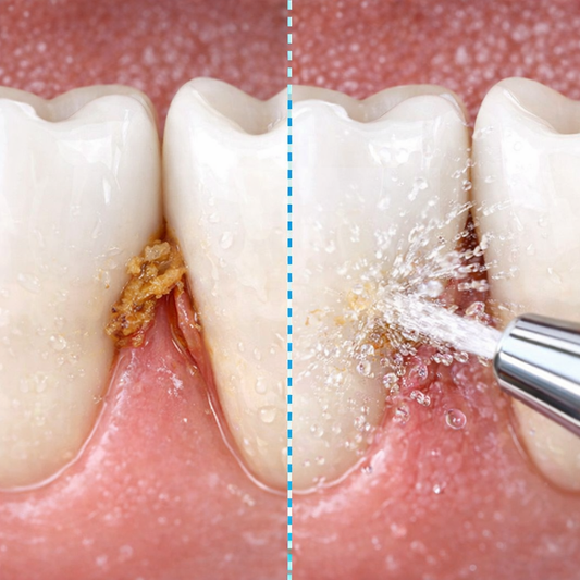 AquaDent Pro - Limpieza profunda tipo dentista desde casa