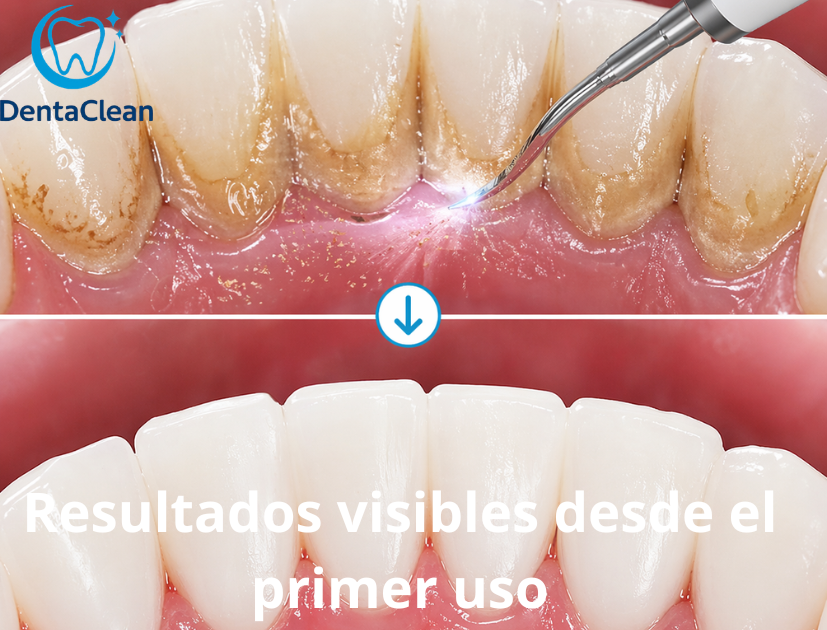 DentaClean  - Elimina el sarro en casa de forma fácil y segura