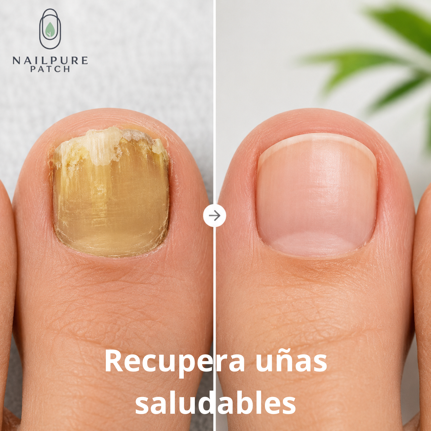NailPure Patch – Ayuda a recuperar uñas más limpias y saludables desde casa (21 un)